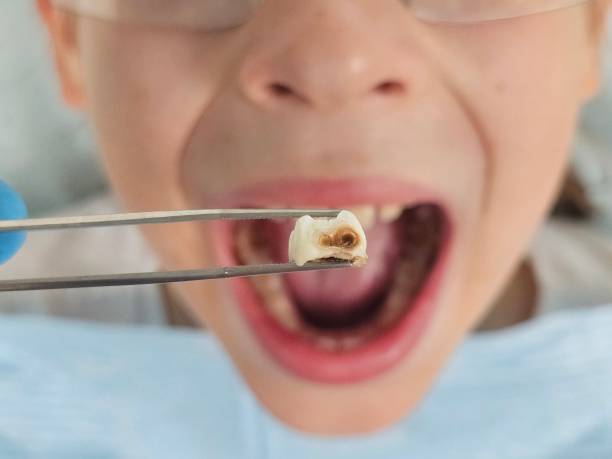 Best Chipped Tooth Repair Near Me  in Juno Ridge, FL